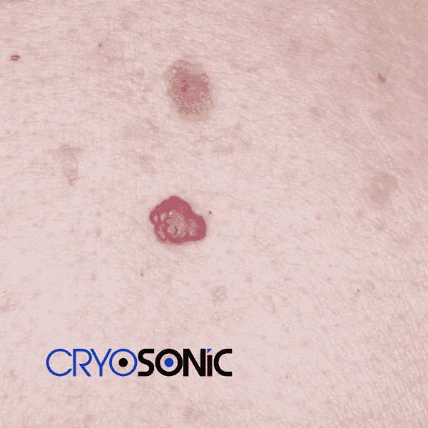 Looking for pain free cherry angioma removal treatment Waterlooville? Call our team today! Waterlooville