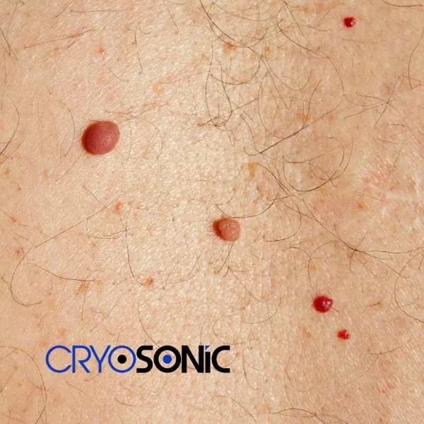 get cherry angioma removal treatment today! Waterlooville