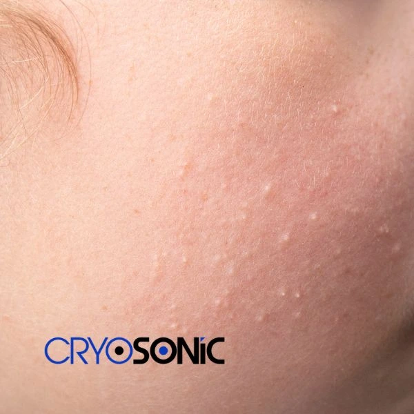 Are you looking for milia removal treatment? Contact our team today Waterlooville