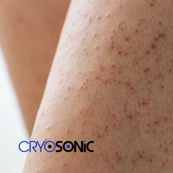 Looking for Seborrhoeic Keratosis removal Waterlooville treatment? Call our consultants today in Waterlooville