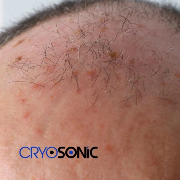 Access Seborrhoeic Keratosis removal from the comfort of your own home! Call us today in Waterlooville