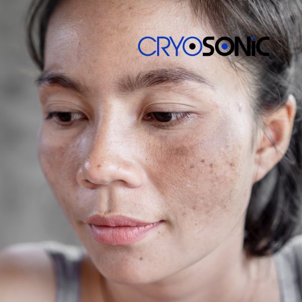 Ready to start age spots removal? Contact our team today in Waterlooville