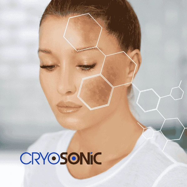 Are you looking for age spot removal treatment? Contact Cryosonic today in Waterlooville
