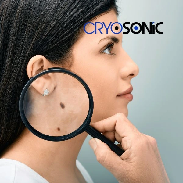 Do you want to learn more about benign moles removal treatment? Call our team today Waterlooville