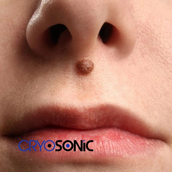 Start your benign moles removal treatment today Waterlooville