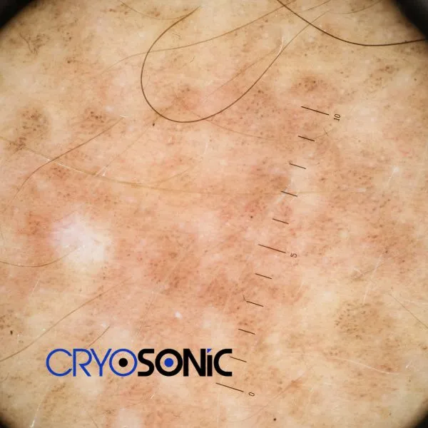 Speak to our team today about sun damaged skin treatment today in Waterlooville