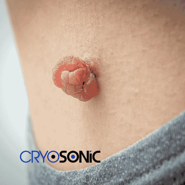 Book your skin tags removal Waterlooville from comfort of your own home! Waterlooville