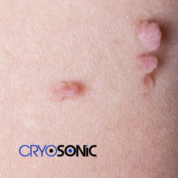 Are you looking for fast effect skin tag removal Waterlooville? Book in NOW! Waterlooville