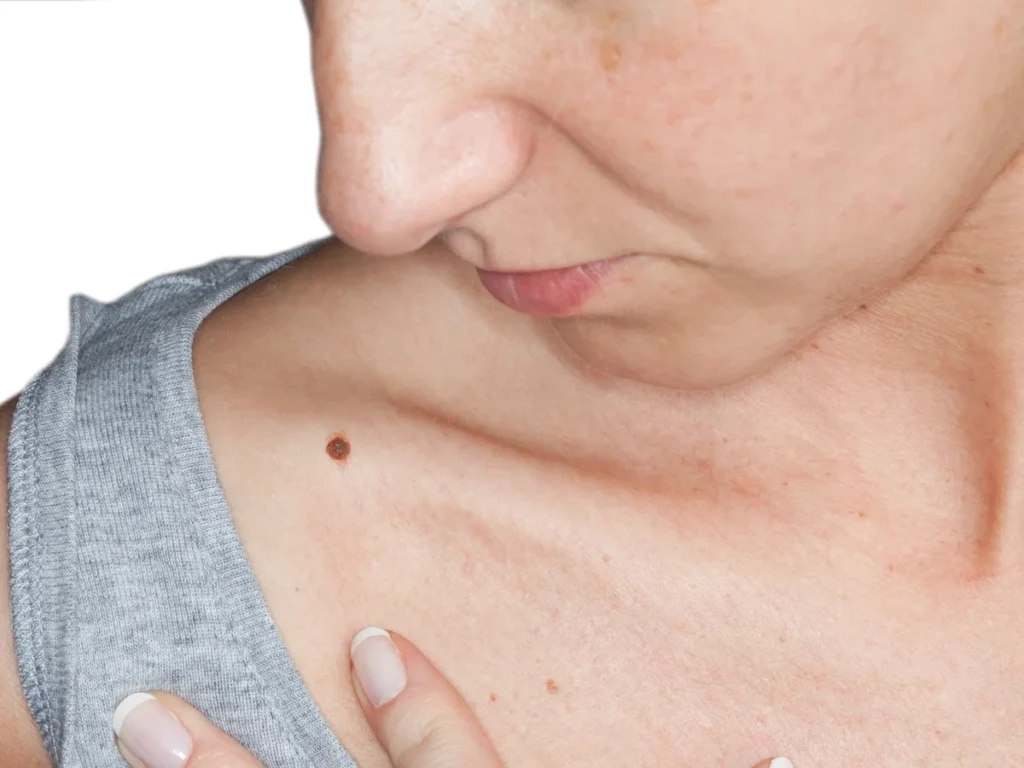 How Does CryoPen Sun Damage Treatment Waterlooville Work? Waterlooville