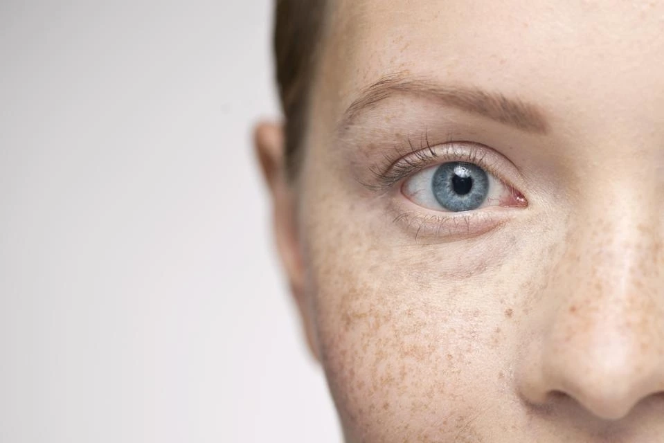 Understanding Sun Damage: How UV Rays Alter Skin and How CryoPen Can Reverse It Waterlooville