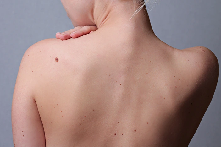 The Skin&rsquo;s Healing Journey After CryoPen Sun Damage Treatment Waterlooville