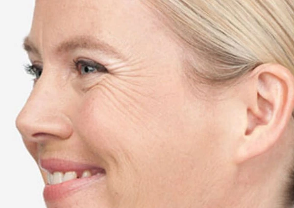 CryoPen Precision vs. Laser: Which Is Better for Sun-Damaged Skin? Waterlooville
