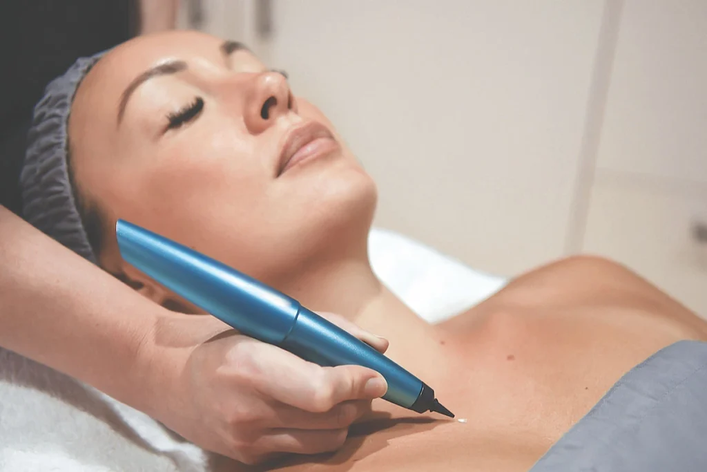 What is CryoPen Technology Waterlooville? Waterlooville