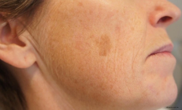 How Many CryoPen Sessions Waterlooville Are Needed for Visible Results Waterlooville? Waterlooville
