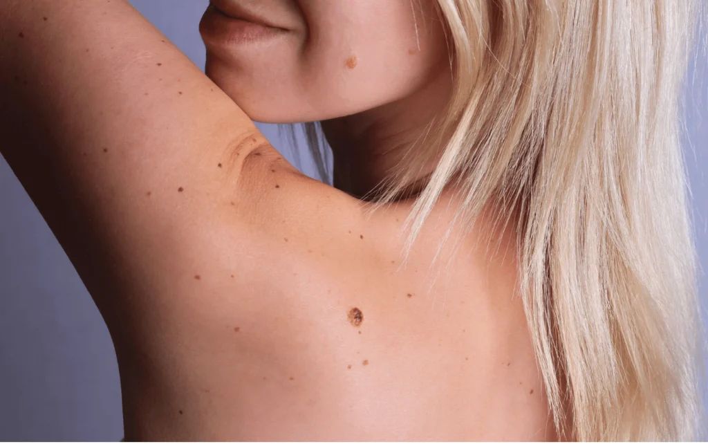 What Are Sun Spots and Pigmentation Waterlooville? Waterlooville