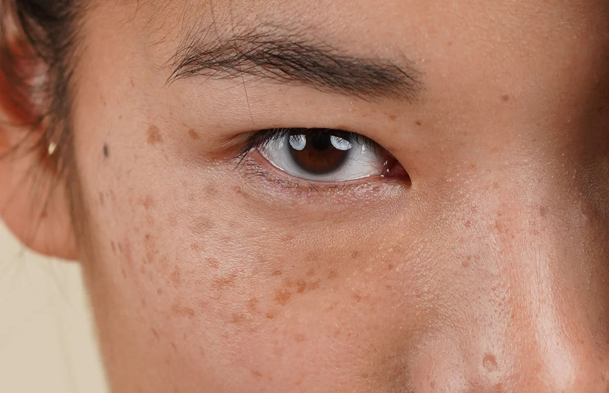 Is There Any Risk of Scarring or Pigmentation Waterlooville? Waterlooville