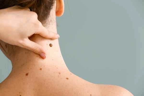 Who Should Avoid CryoPen Treatments? Waterlooville