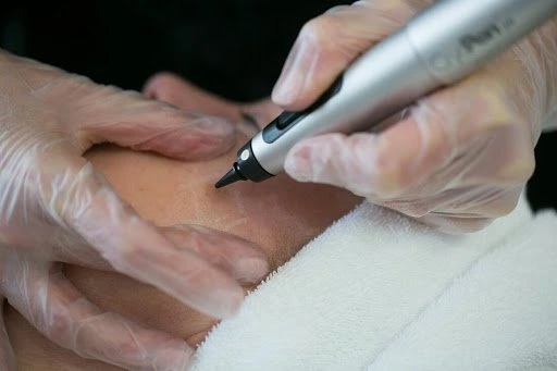 The CryoPen Technology Explained: How Extreme Cold Removes Sun-Damaged Skin Cells Waterlooville