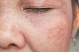 CryoPen Precision vs. Laser: Are Both Treatments Safe? Waterlooville