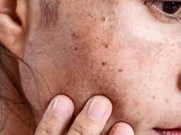 Why CryoPen Works Best for Isolated Sun Spots and Pigmentation Waterlooville