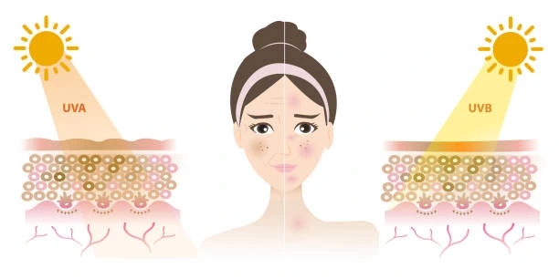 Understanding Sun Damage Waterlooville : How Do UV Rays Cause Changes in the Skin? Waterlooville