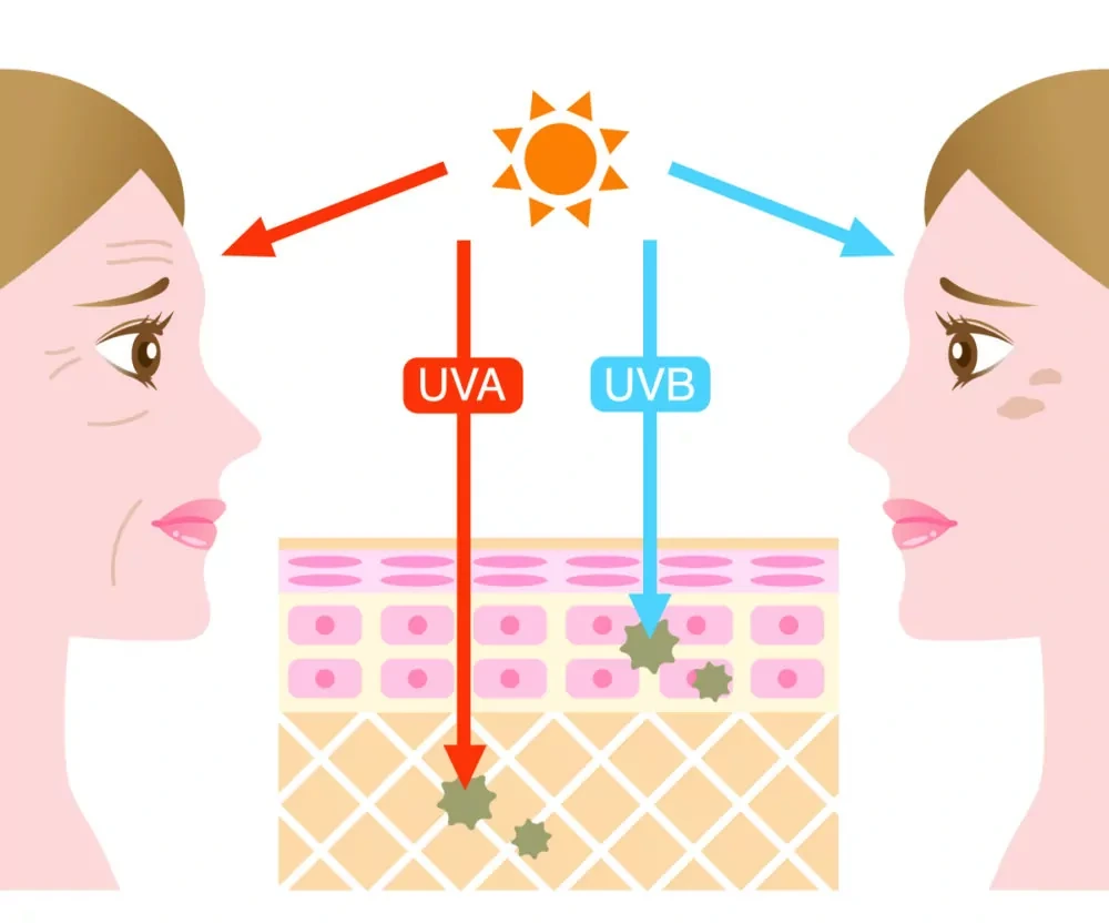 Understanding Sun Damage Waterlooville - Why Should Sun Damage Be Treated Early? Waterlooville